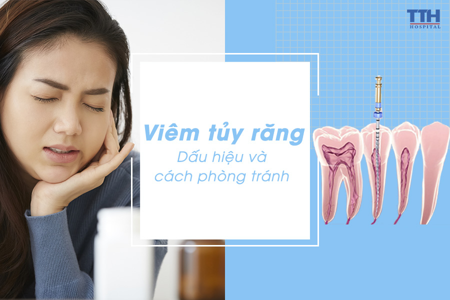 Viêm tủy răng - Dấu hiệu và cách phòng ngừa